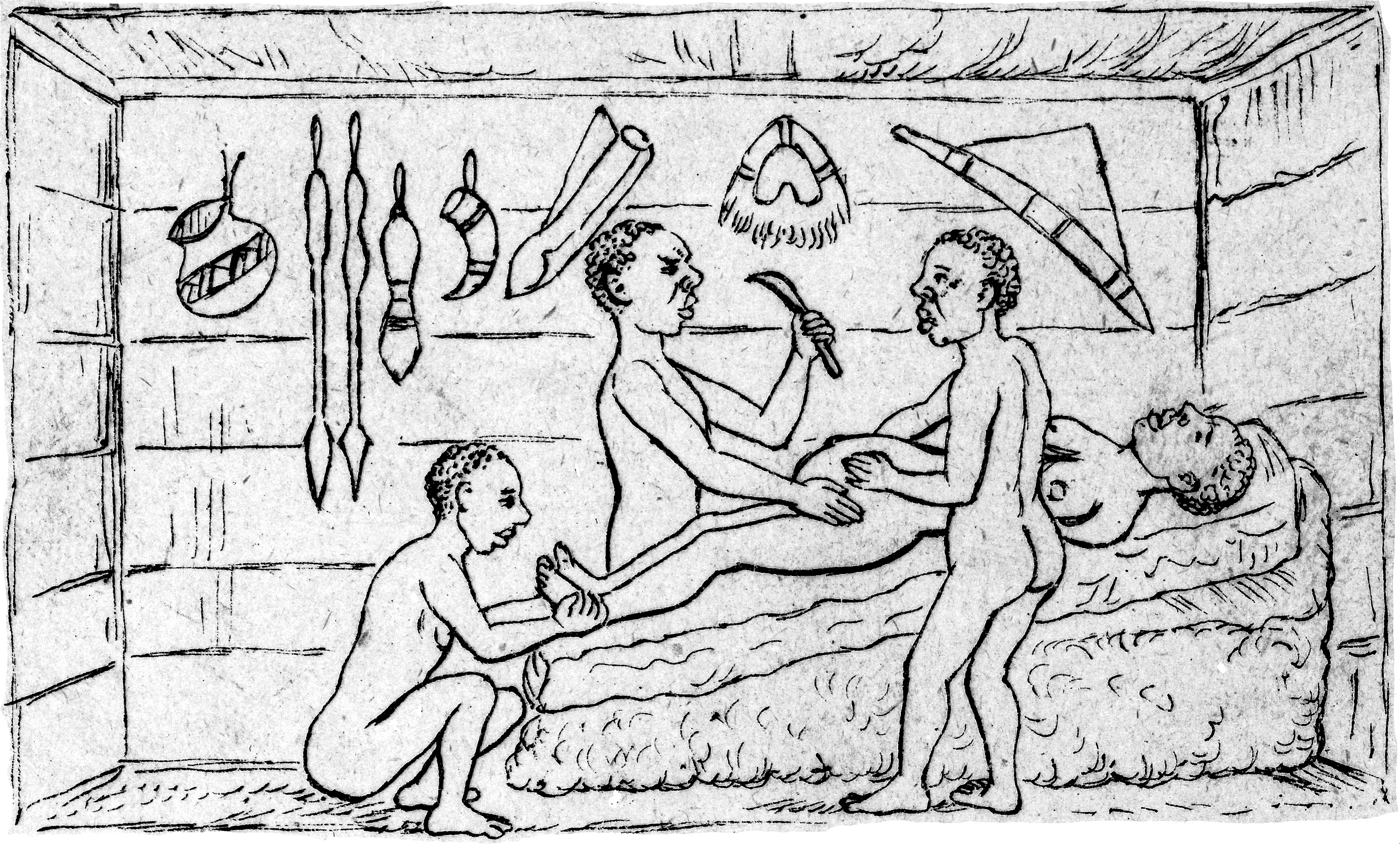 1879년 부뇨로 왕국의 카후라에서 원주민 치료사들이 시행한 제왕절개 수술. 의료 선교사 로버트 윌리엄 펠킨이 관찰했다.