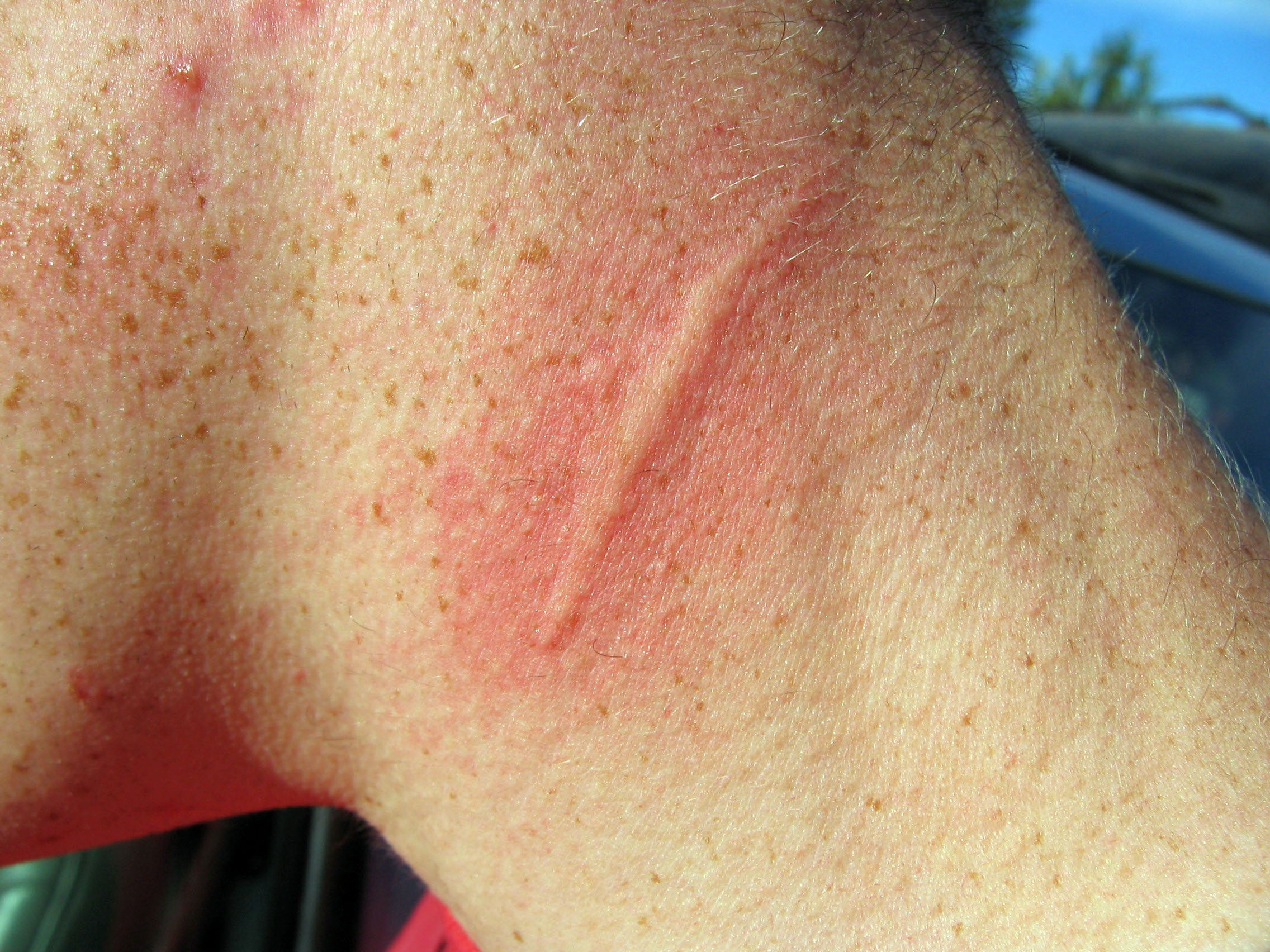 손목에 생긴 팽진