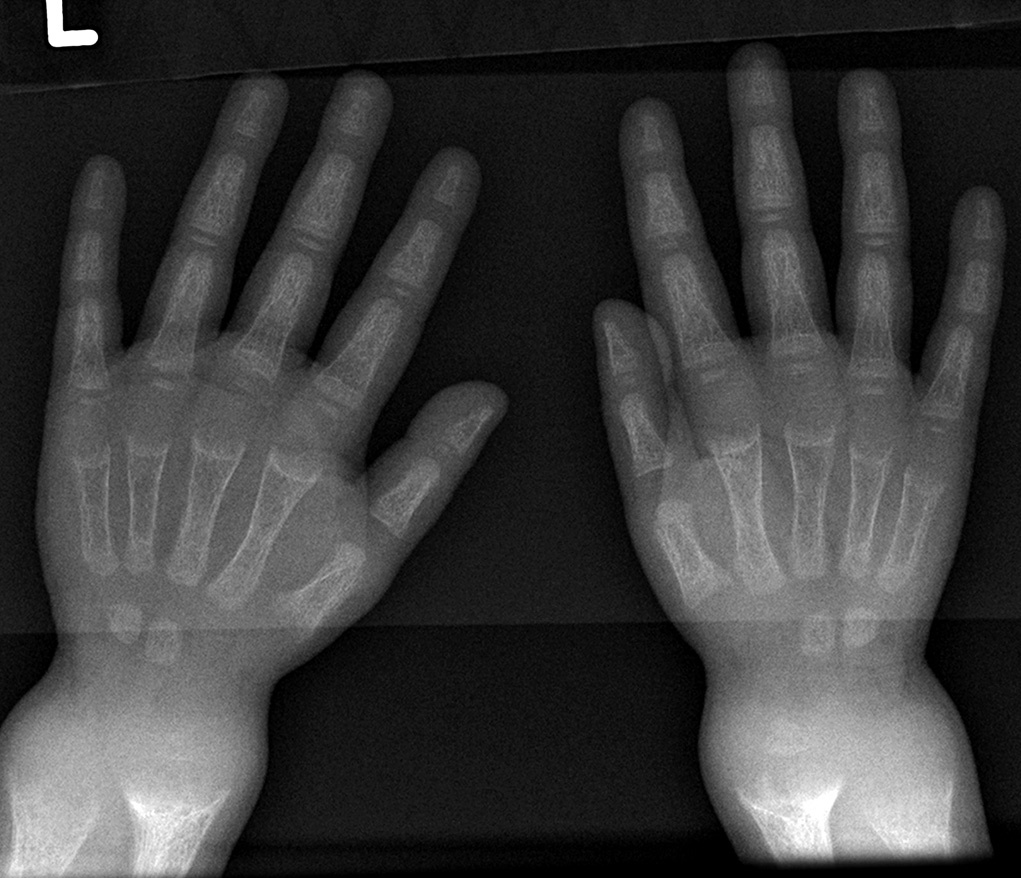 구루병을 보여주는 손목 엑스레이 사진. 주로 컵 모양 변형이 보임.