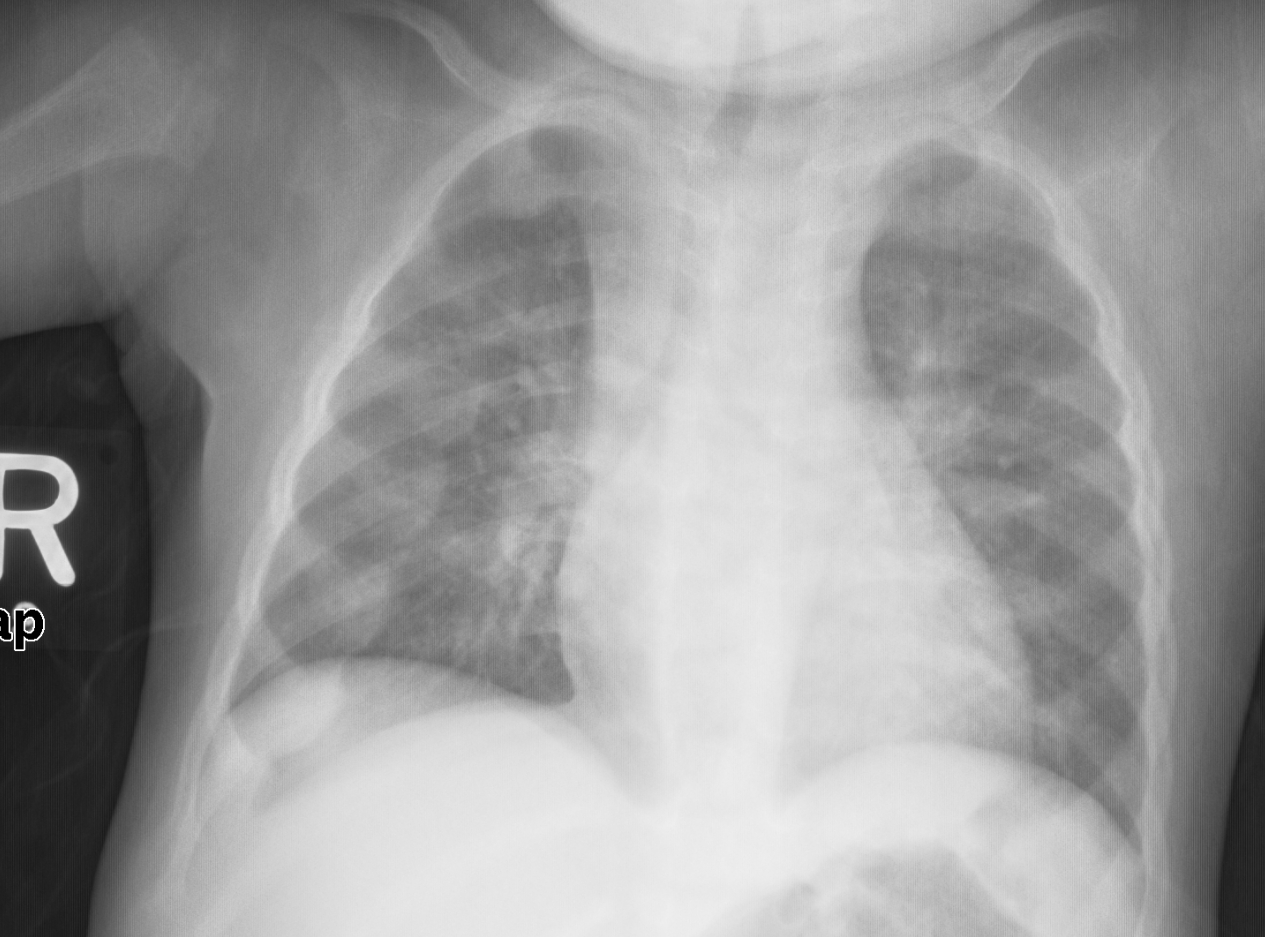 구루병과 일치하는 변화를 보여주는 흉부 엑스레이 사진. 이러한 변화는 일반적으로 구루병의 