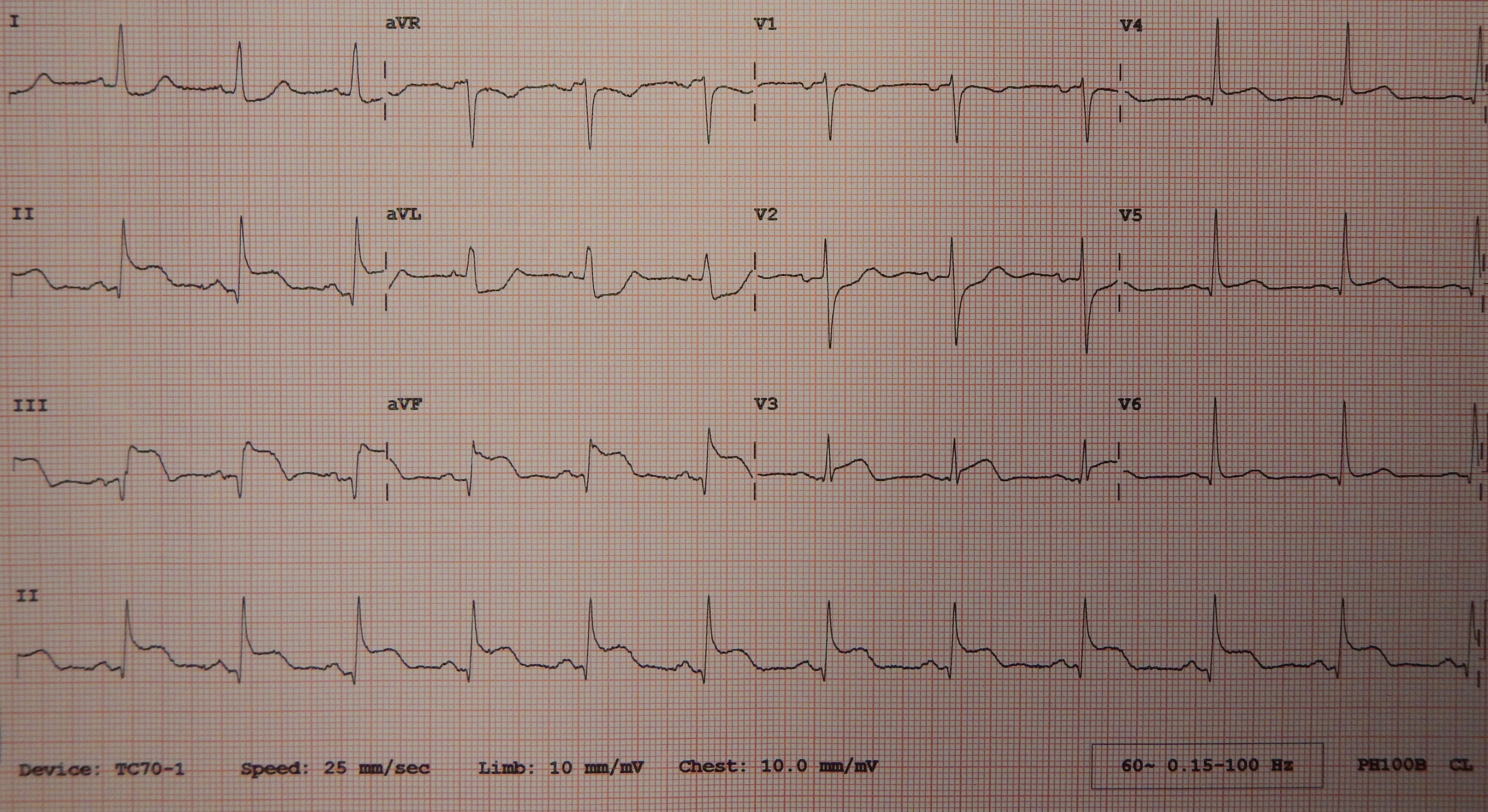우심실 심근경색(STEMI)을 보여주는 12-유도 심전도. 오른쪽 관상동맥의 관류 감소로 인해 나타남. II, III, aVF 유도에서 ST분절의 상승이 관찰됨.