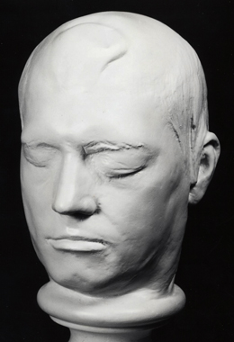 The entry damage to Gage's left cheek, and the raised bone fragment in the exit area above his forehead, are visible in this plaster cast taken in late 1849.