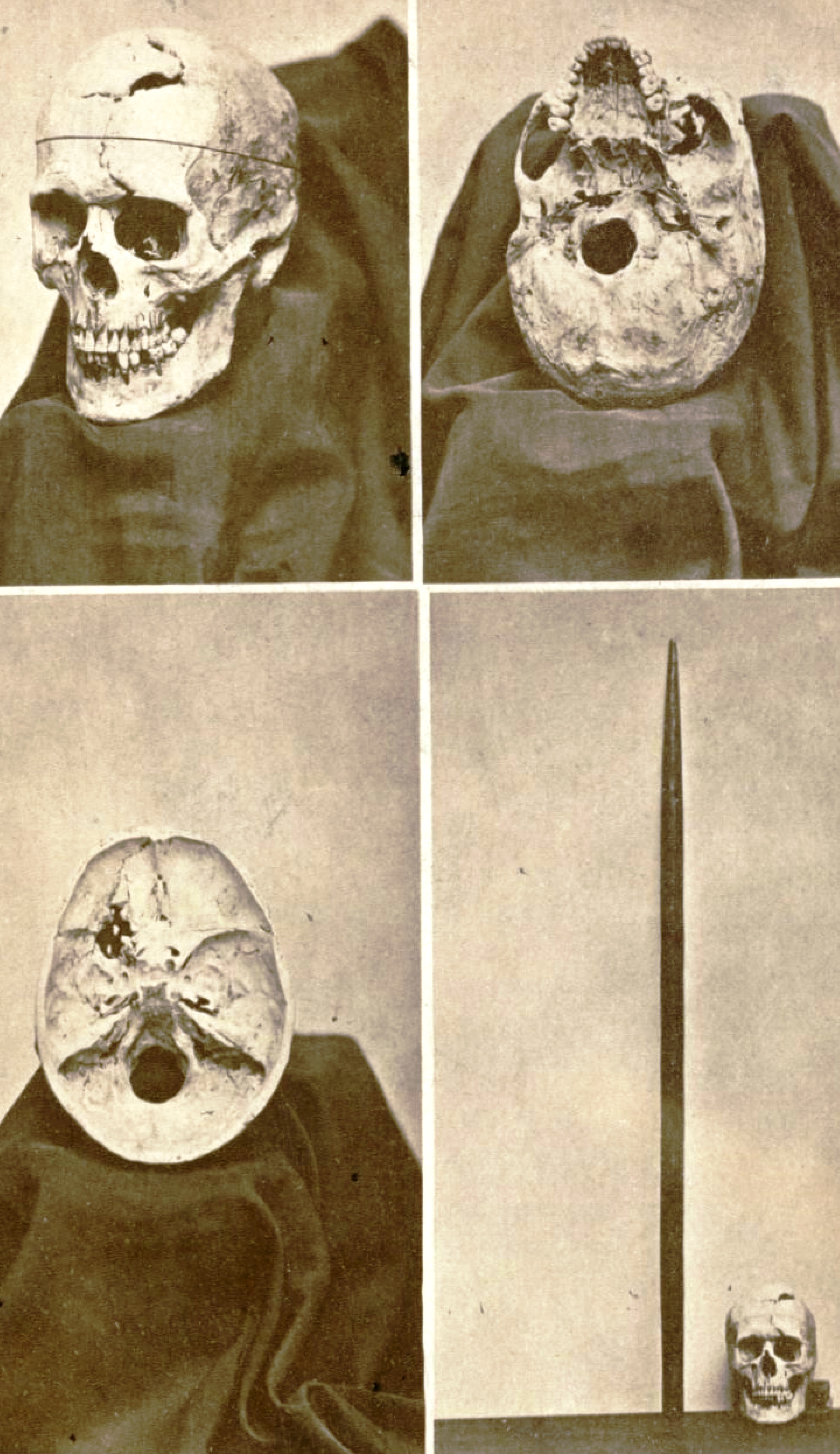 Gage's skull (sawed to show interior) and iron, photographed for Harlow in 1868. Harlow wrote,