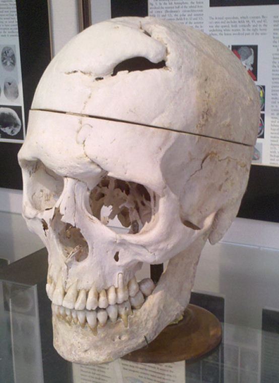 Gage's skull, the