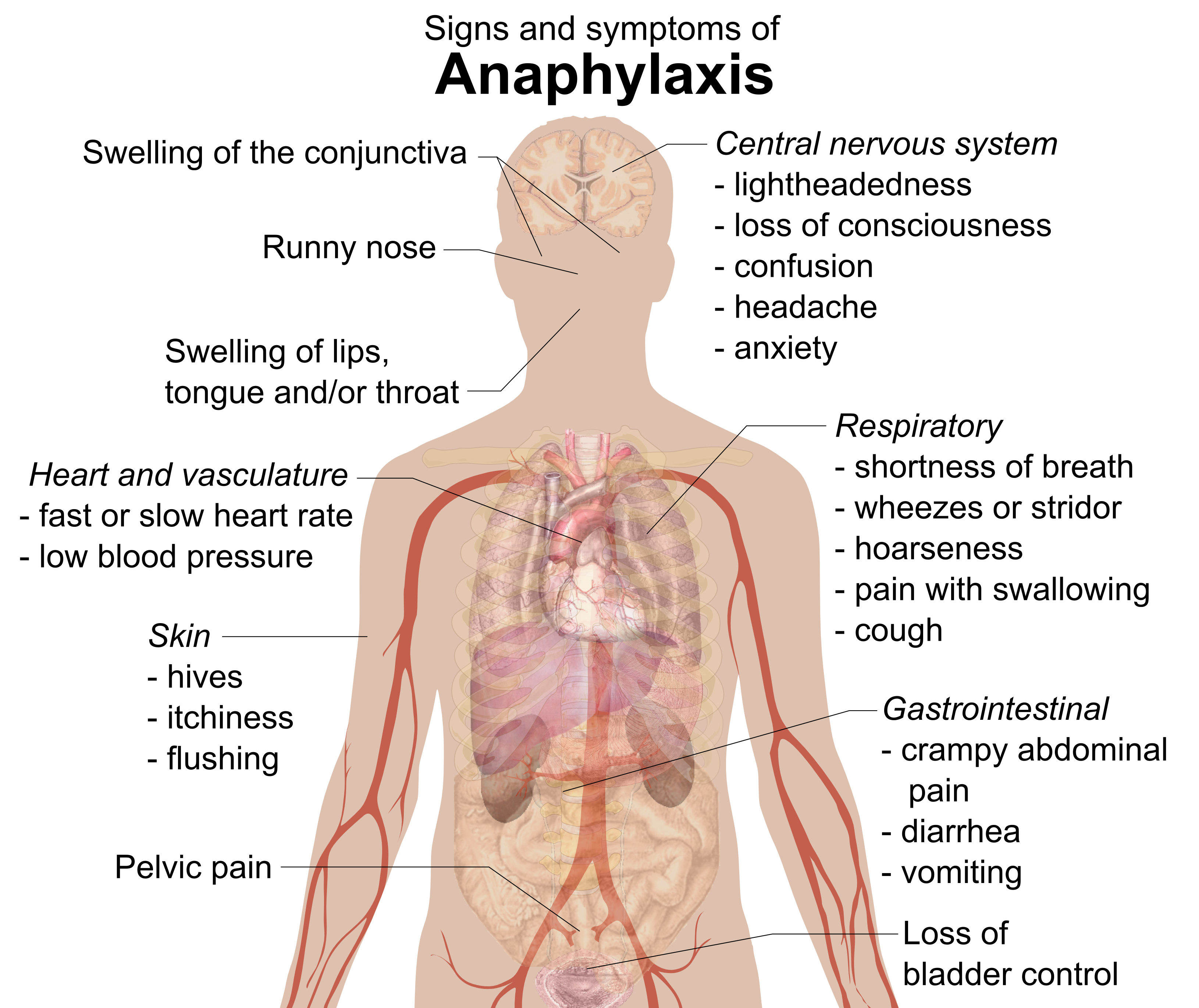 아나필락시스의 징후 및 증상