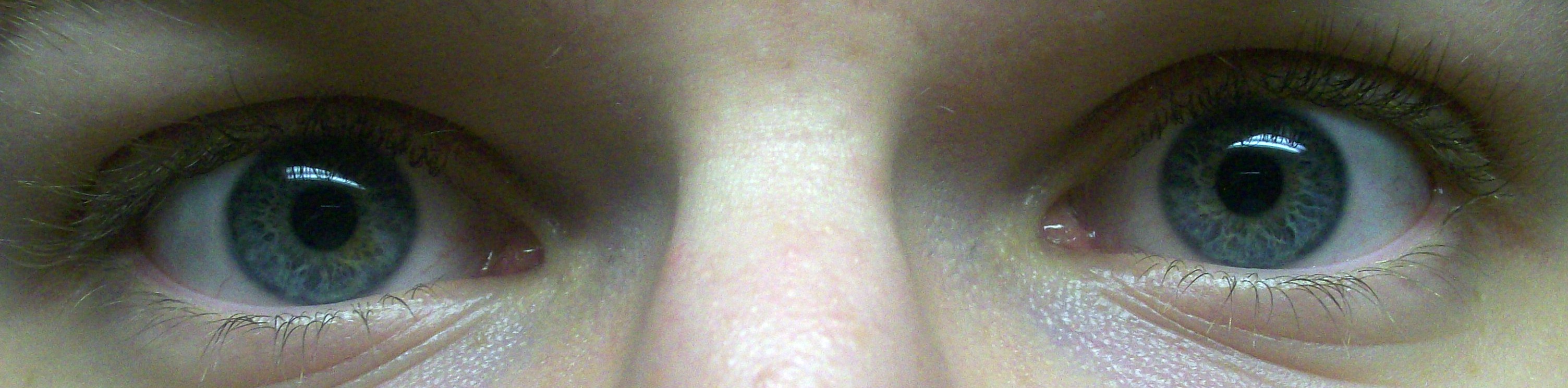 Eyes open and pupils equal-dilation, normal size
