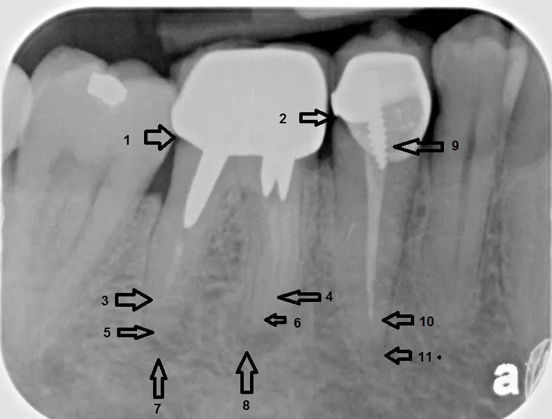 X-ray explanation of bad root canal therapy