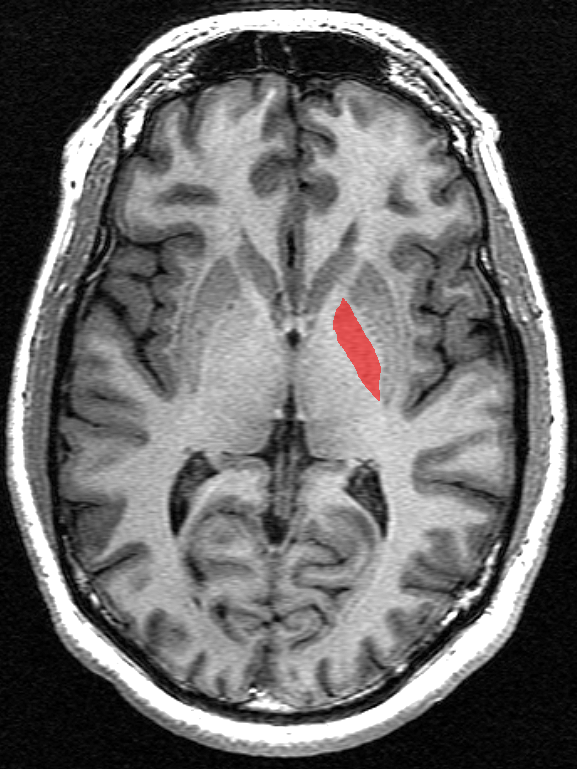 구조적 MRI 영상에서 창백핵의 가로 단면.