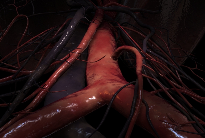 A 3D animation still of the junction between the common iliac artery and the lower abdominal aorta
