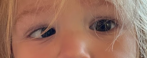 오른쪽 눈에 조절 내사시가 있는 어린이. 왼쪽 눈은 앞을 향하고 오른쪽 눈은 코 안쪽을 향하고 있다.